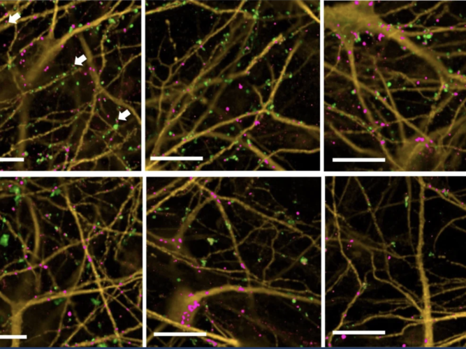 Synapses, shown as green and pink dots, represent points of communication between neurons, grown here in the laboratory from stem cells. The study found that neuronal cultures from some Alzheimer's patients were more resilient to synapse loss after exposu
