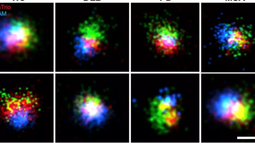 Fluorescence microscopy images comparing C-terminal and N-terminal alpha-synuclein staining across healthy controls (HC) and samples from DLB, Parkinson’s disease (PD), & multiple system atrophy (MSA). Red, green, & blue signals show protein localisation